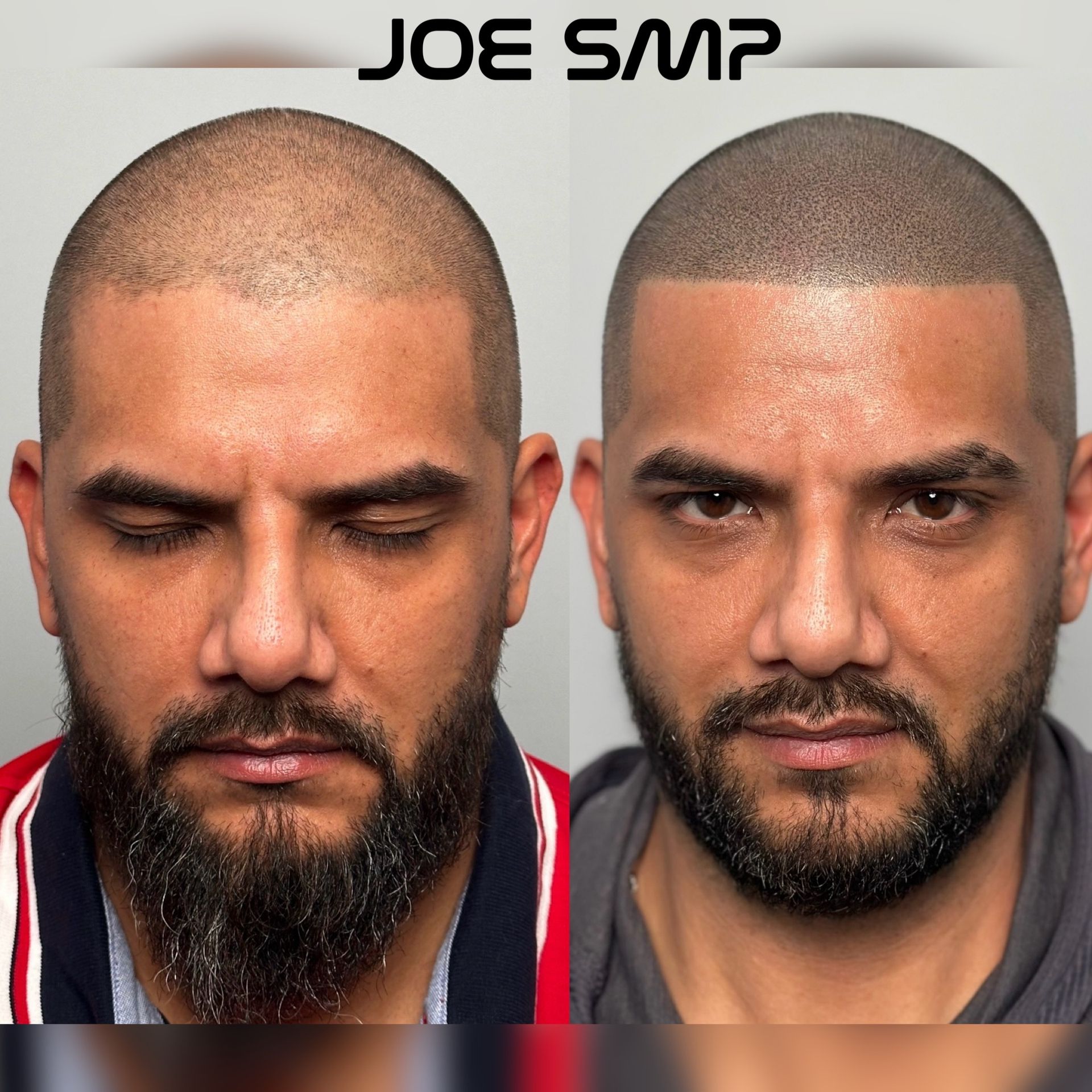 Side-by-side comparison of a man before and after scalp micropigmentation. The procedure darkens the scalp, creating the appearance of a fuller hairline.