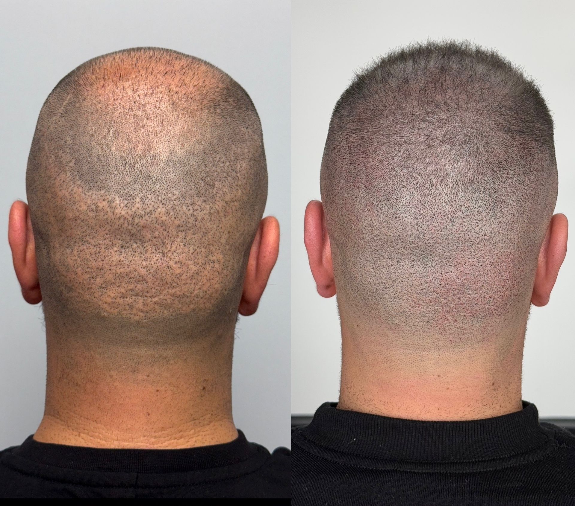 Before and after view of a shaved head. Left side shows sparse hair, right side shows a denser appearance, possibly SMP.