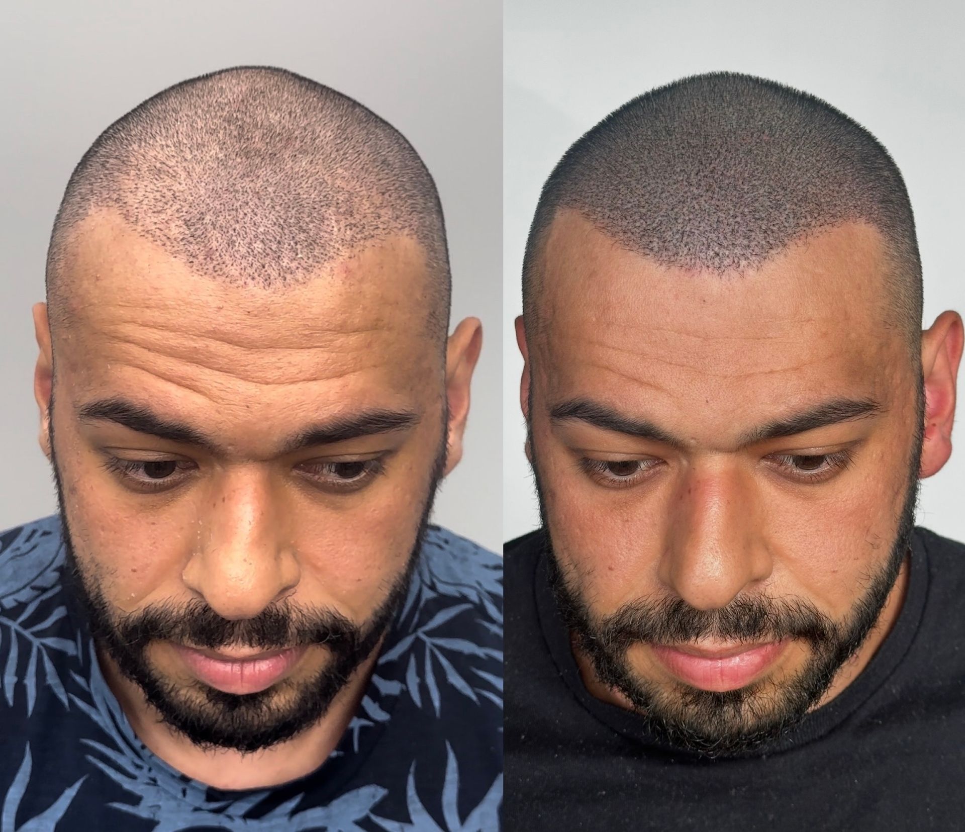 Two side-by-side photos of a man's head. The left shows a thinning hairline; the right shows a scalp micropigmentation.