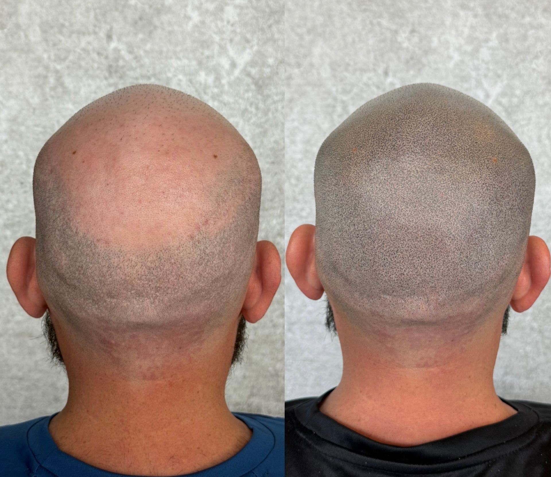 Before and after of a shaved head; scalp micropigmentation creates the appearance of stubble.