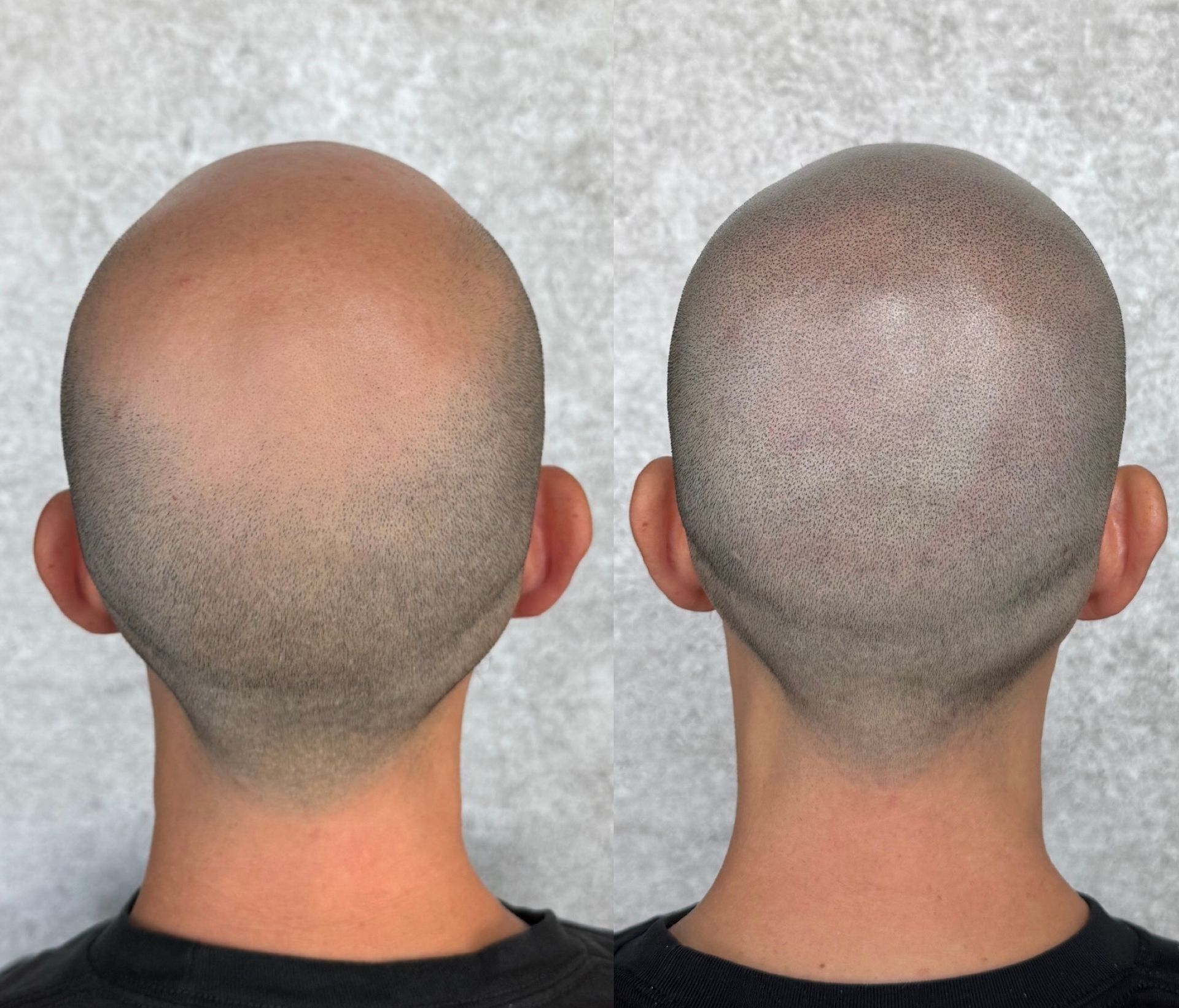 Before and after of a shaved head. The right side has a stippled pattern, suggesting a scalp micropigmentation treatment.