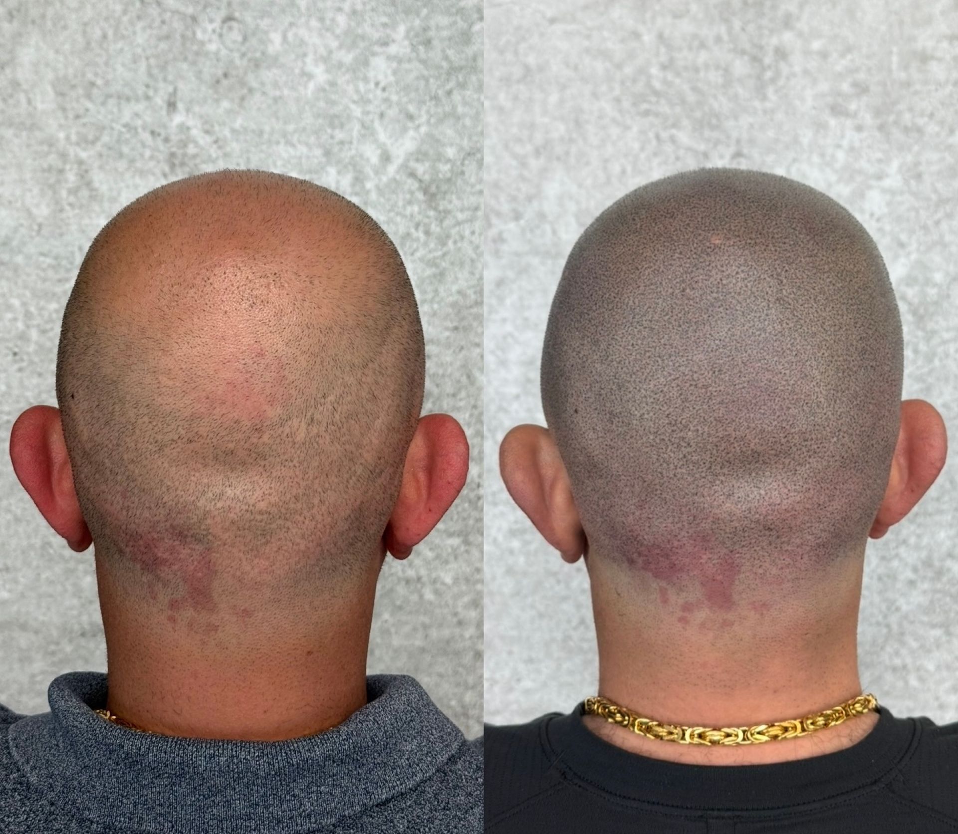 Before and after views of a shaved head. Scalp micropigmentation creates a fuller appearance.