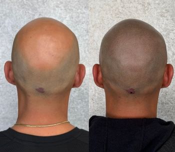 Two photos side-by-side: a bald head before and after scalp micropigmentation, changing the skin color.