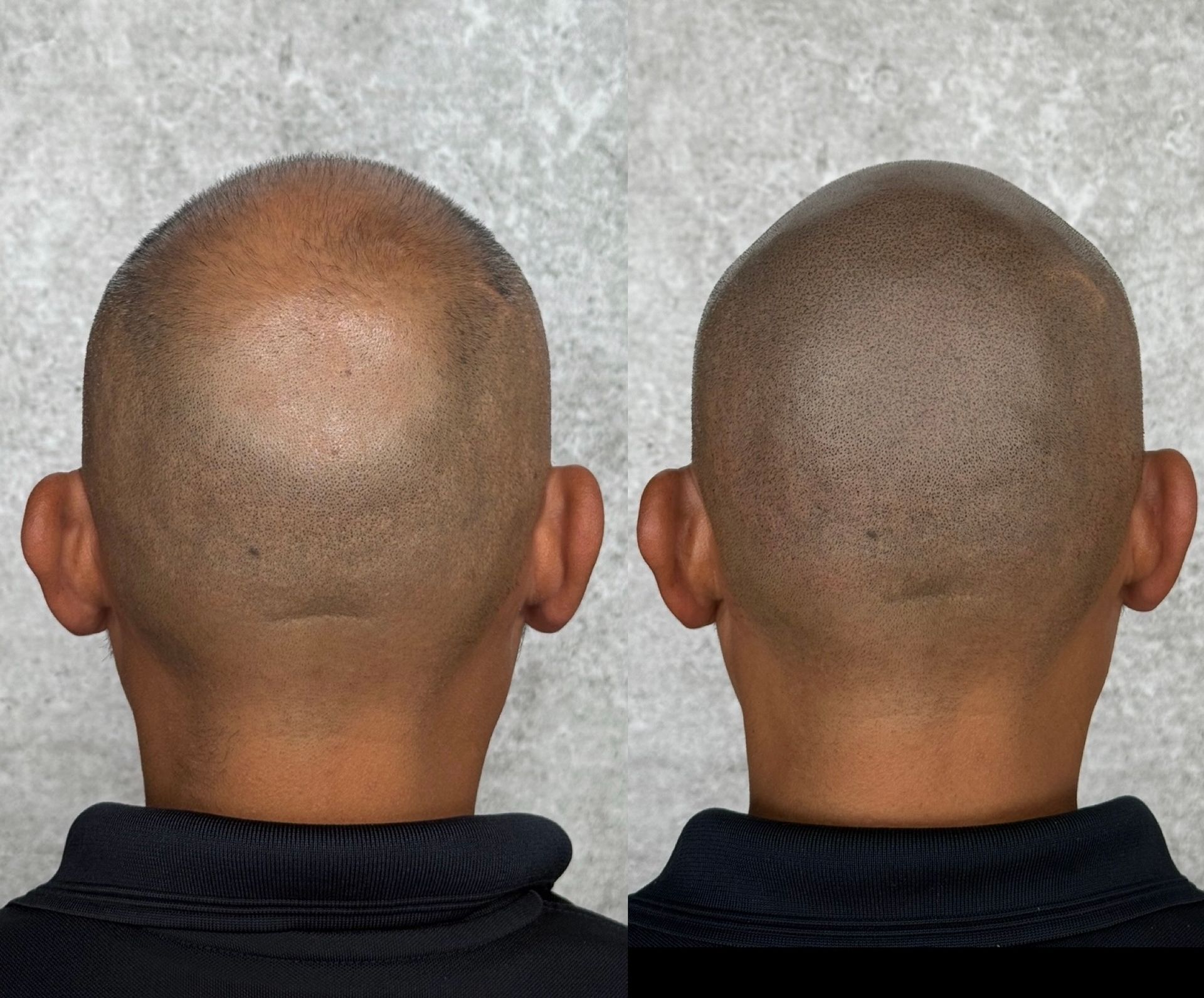 Comparison of a bald head before and after scalp micropigmentation, showing enhanced hair density.