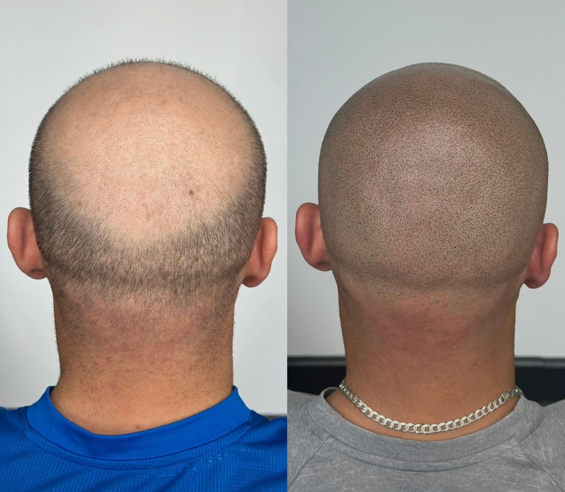 Comparison: Scalp with hair loss on left, scalp with SMP (Scalp Micropigmentation) on right.