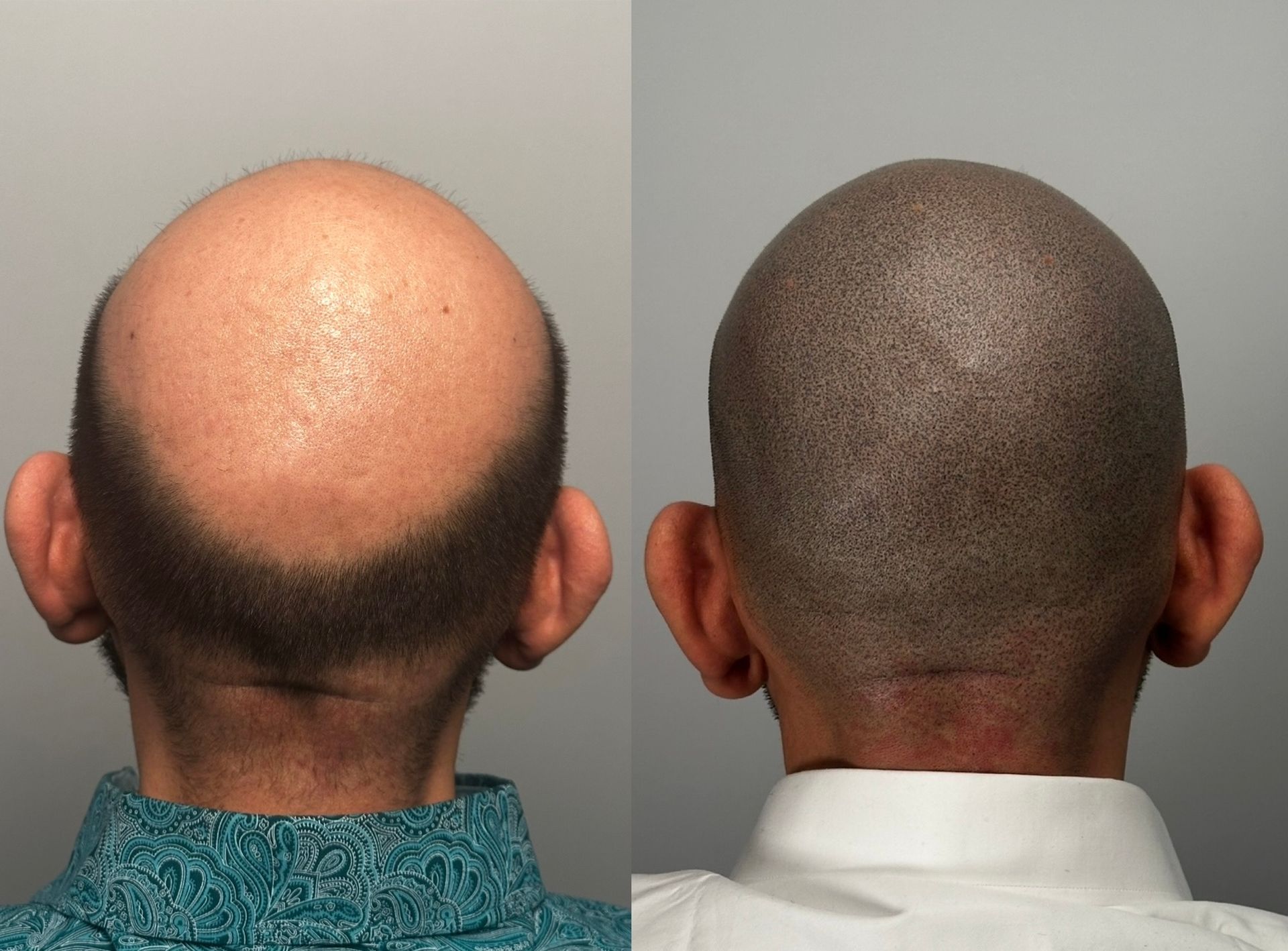 Before and after view of scalp micropigmentation, creating the illusion of a shaved head.