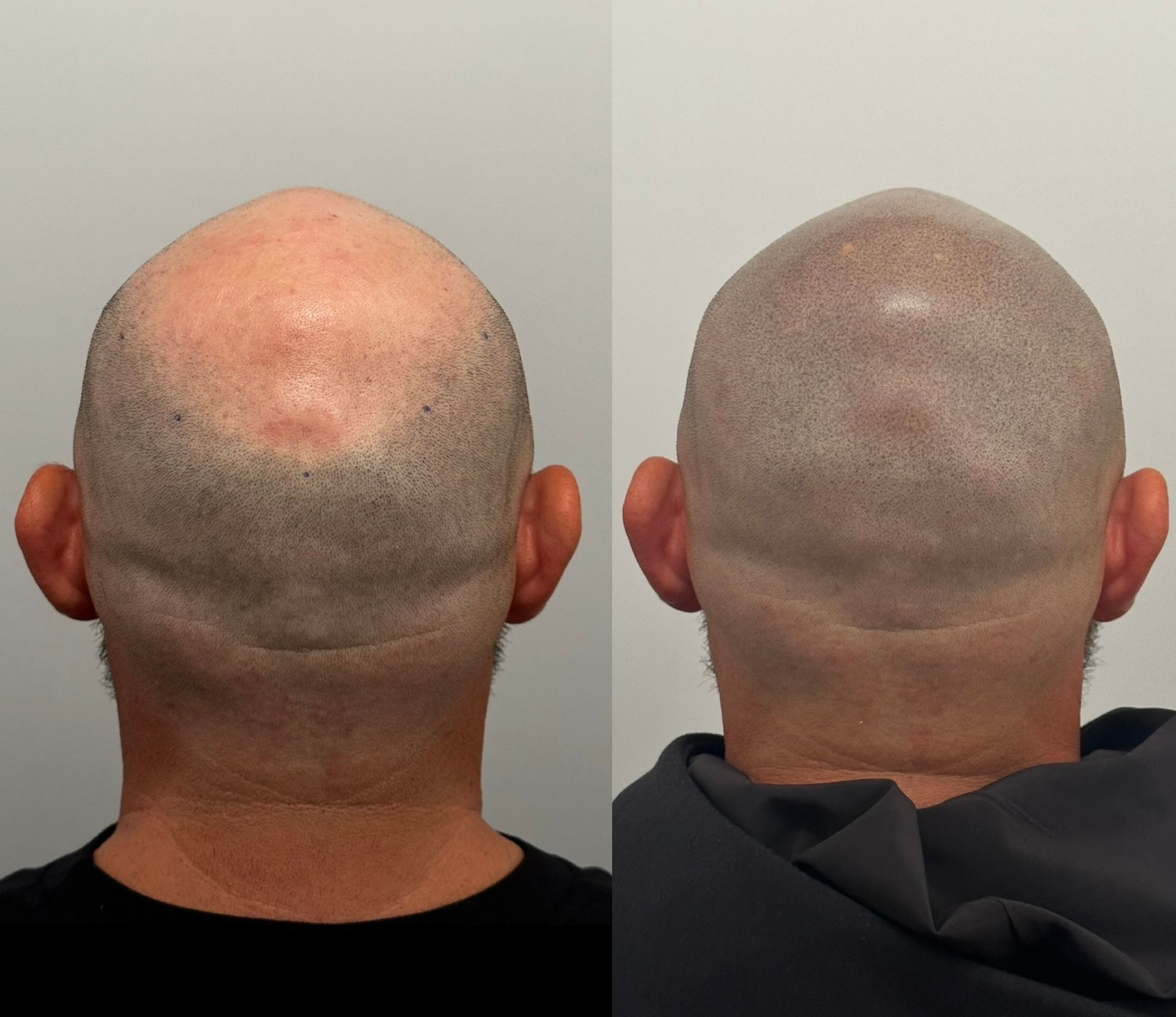 Two views of a bald head: before and after scalp micropigmentation.