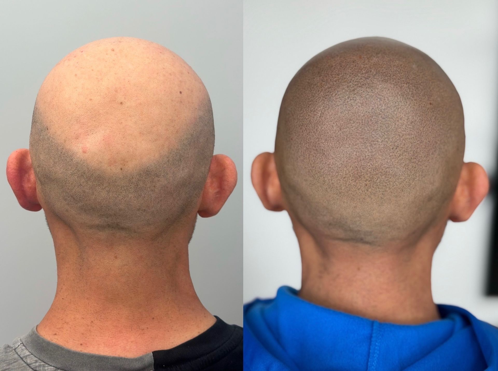 Before and after view of a bald head; hairline restoration with scalp micropigmentation.