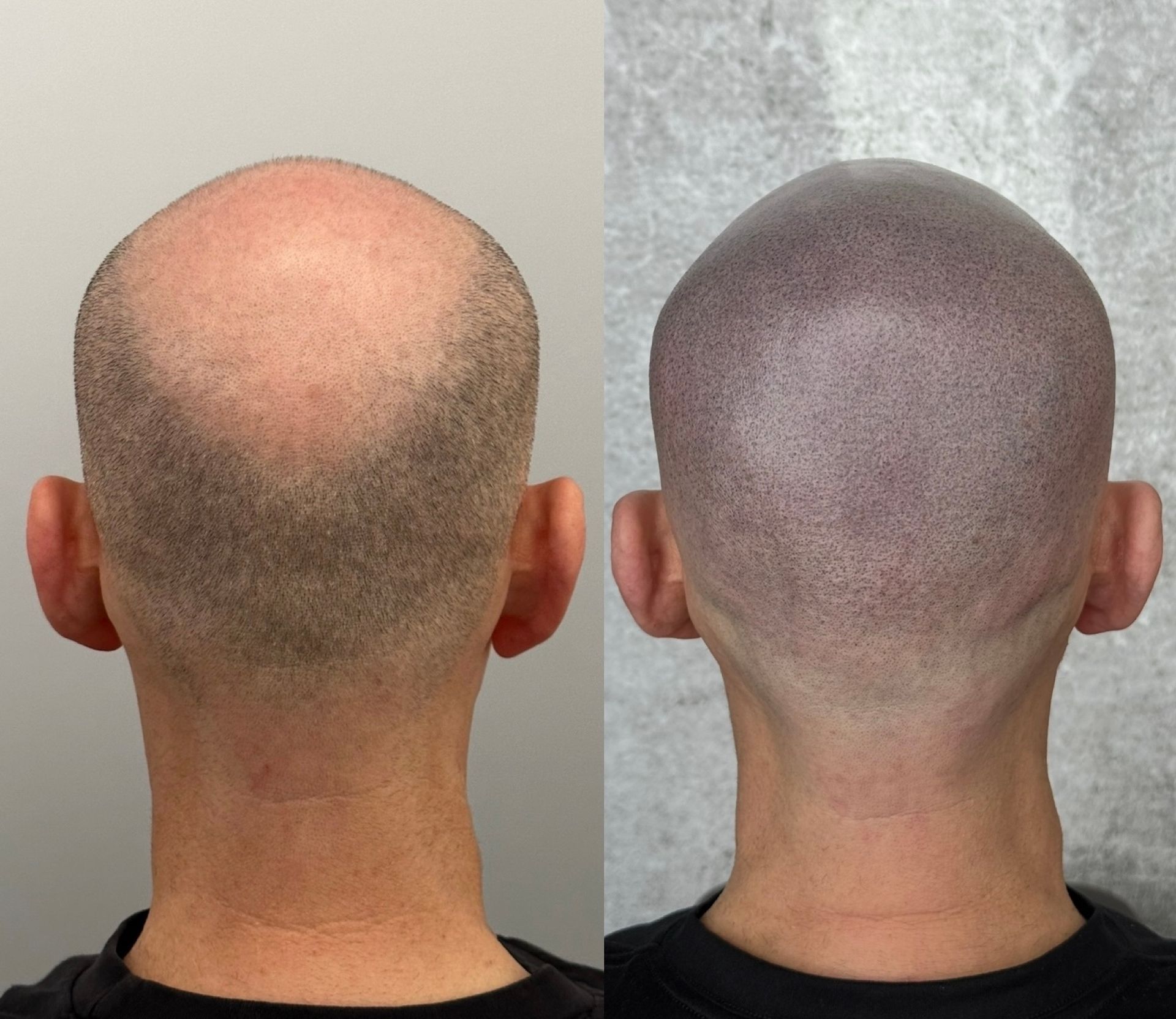 Before and after view of a shaved head with scalp micropigmentation, creating a fuller hair appearance.
