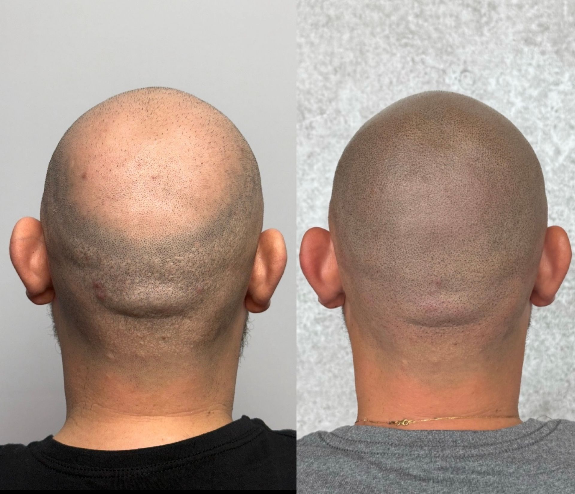 Before-and-after of scalp micropigmentation on a man. Scalp appears fuller, more even-toned after treatment.