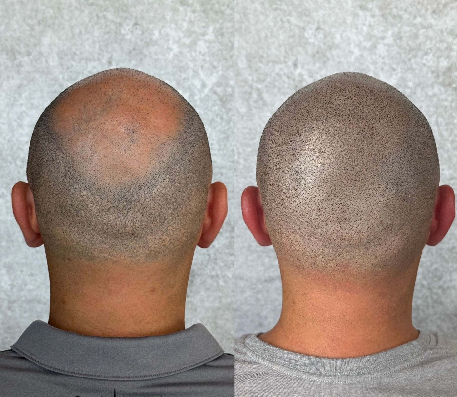 Scalp micropigmentation before-and-after showing hair loss coverage on the back of a person's head.