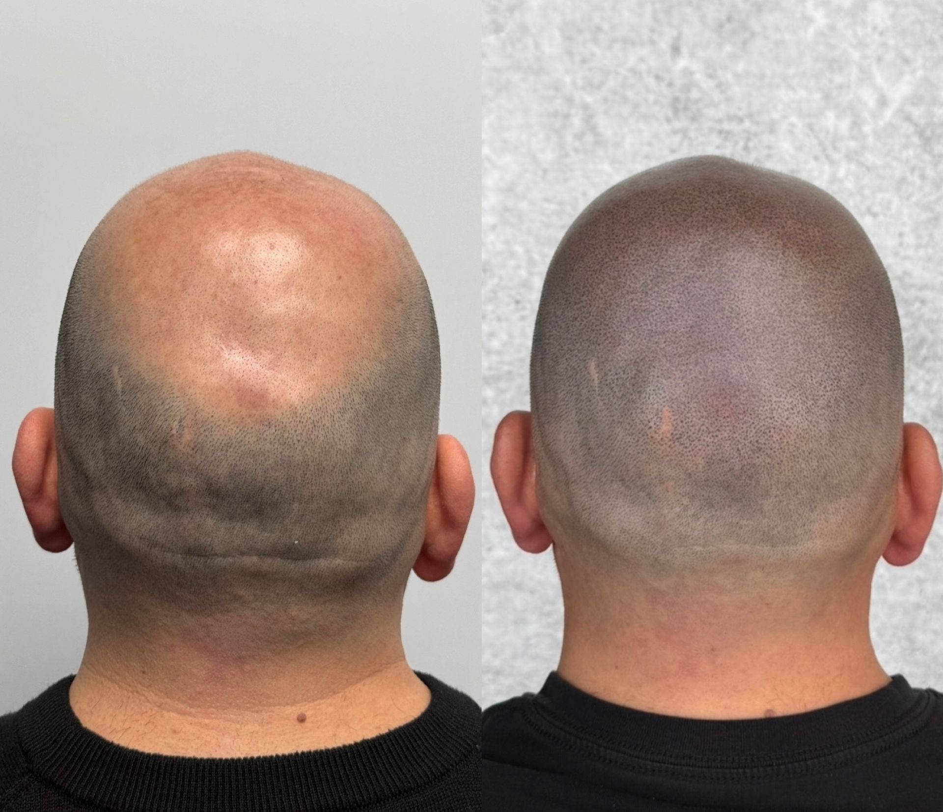 A balding man's head before and after scalp micropigmentation treatment. Skin tone and hair follicle replication are shown.