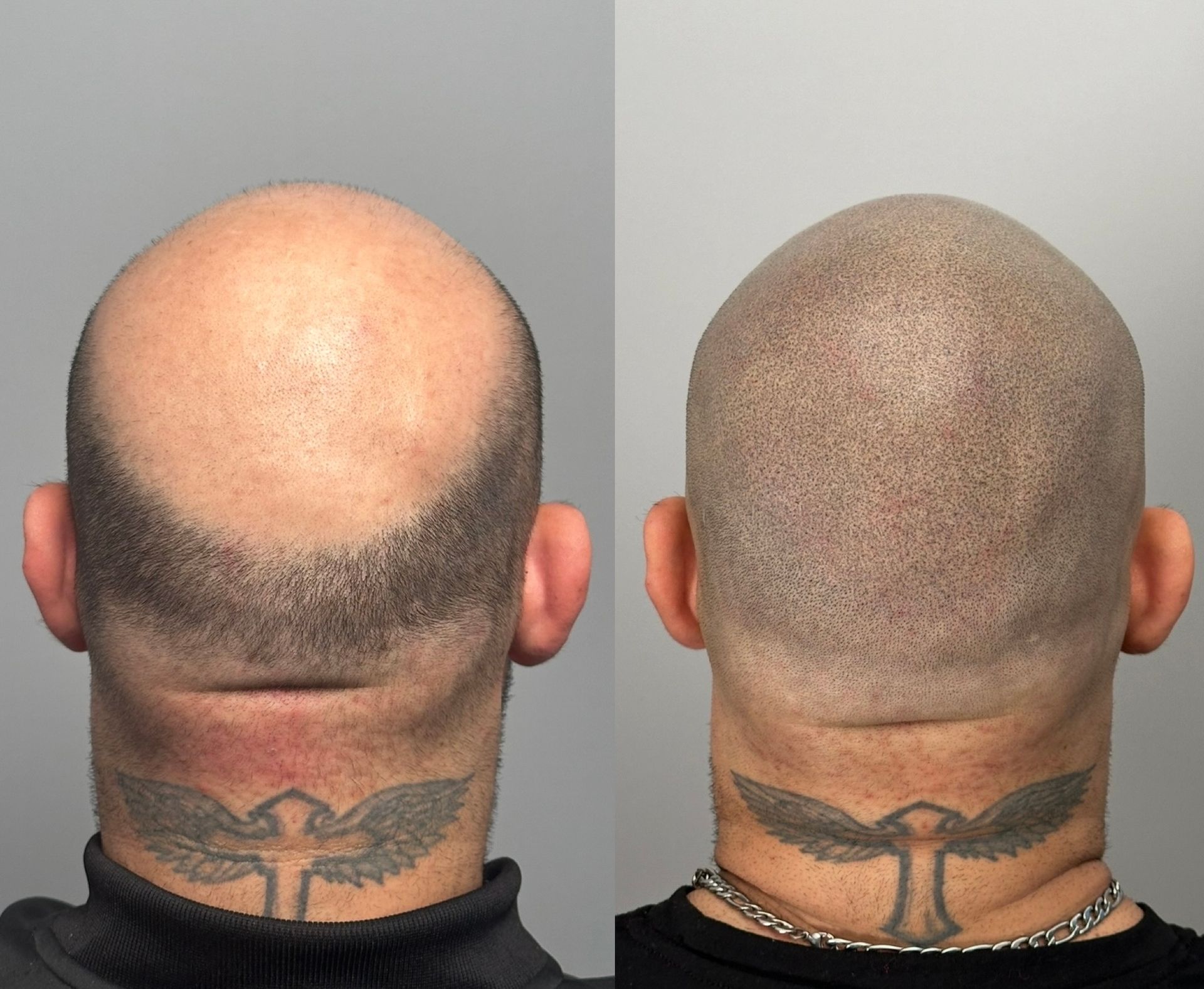 Before-and-after of shaved head. Right side with hair follicle simulation tattoo, concealing thinning. Same neck tattoo visible.
