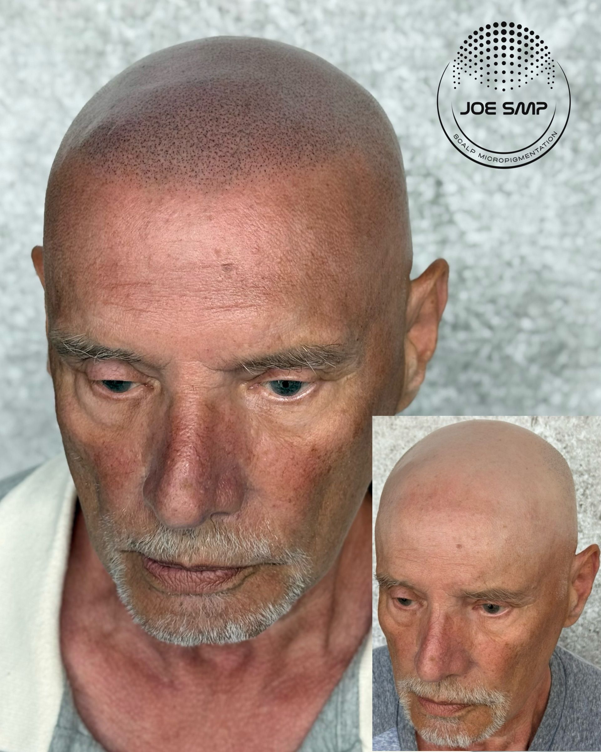 Man with shaved head, before-and-after scalp micropigmentation. 