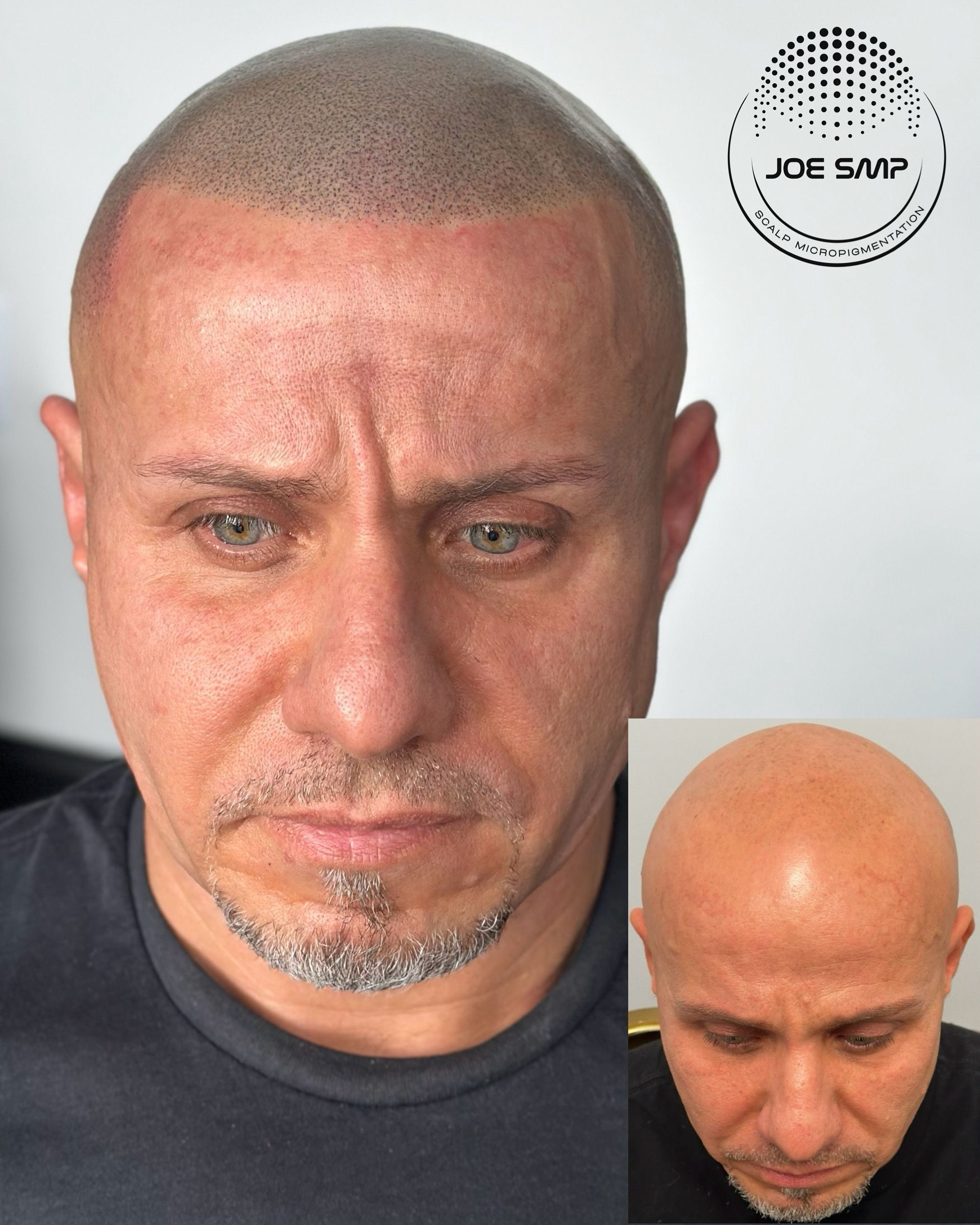 Man with shaved head, before and after Scalp Micropigmentation (SMP) treatment. Dark dots simulate hair follicles.