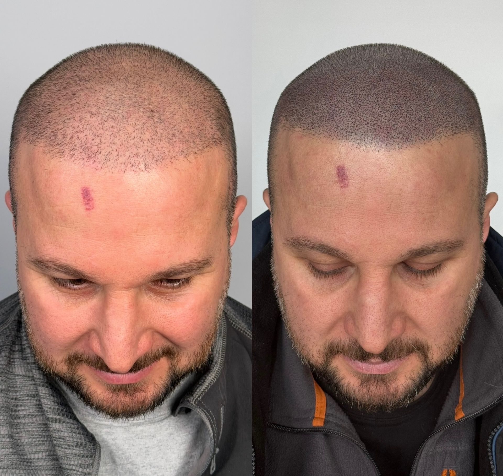 Before and after views of a man's scalp. Baldness is replaced with a simulated hairline. Small red mark visible.