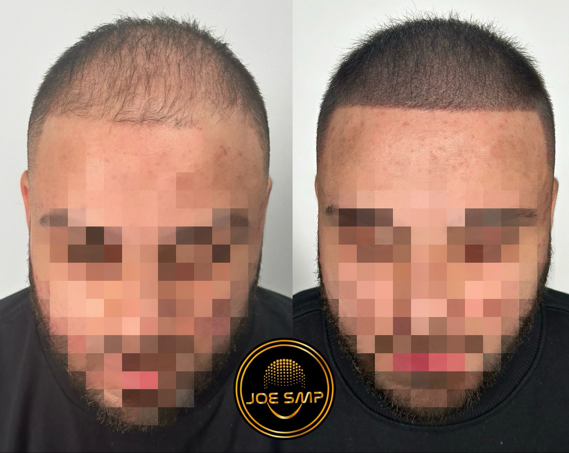 Before and after head comparison. Hair loss improvement using SMP. Man's head with receding hairline, then with a filled-in hairline.