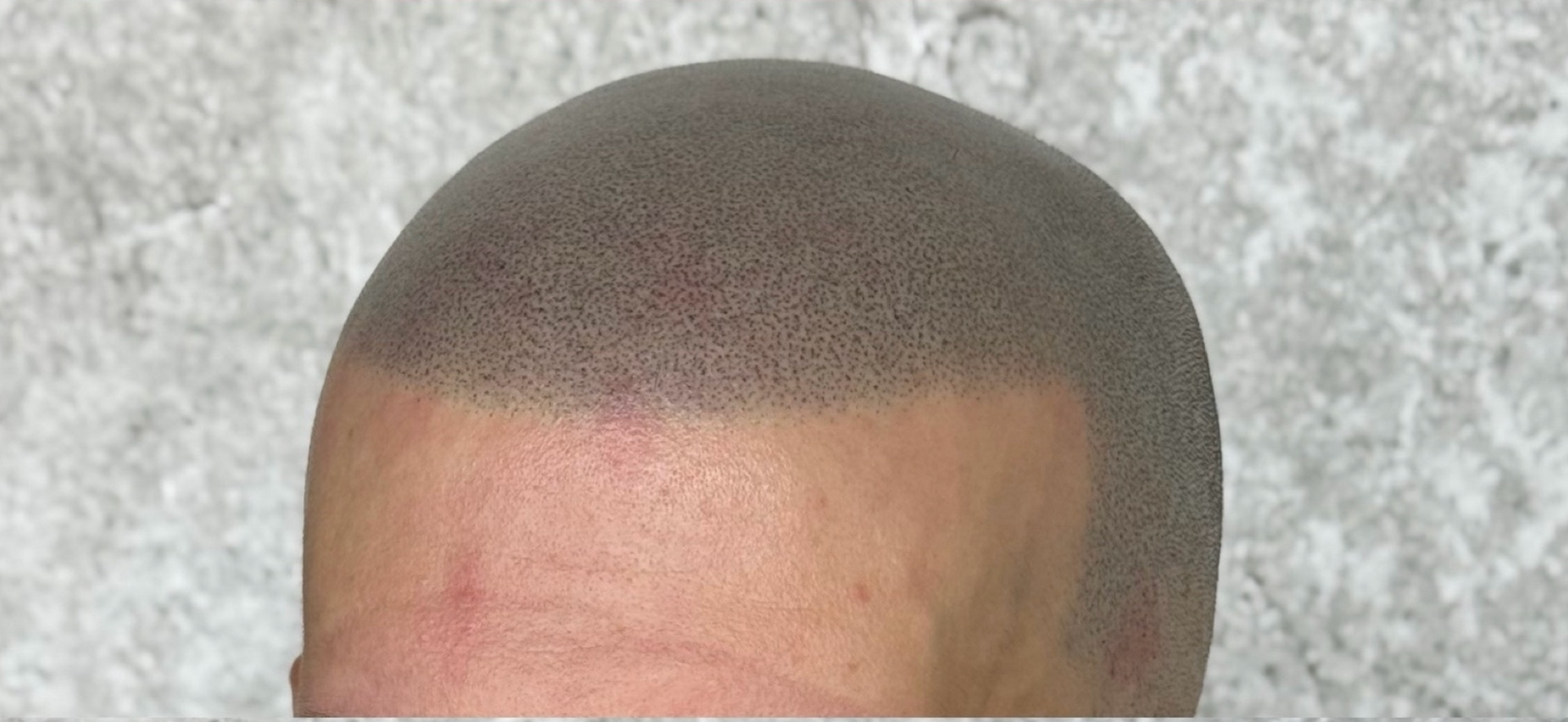 Scalp with a hair tattoo procedure, dark dots in a line on the head.