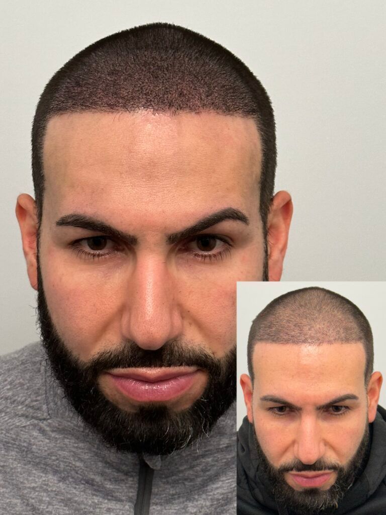 Man with shaved head; hair transplant. Two photos: one front view and inset a top-down view.