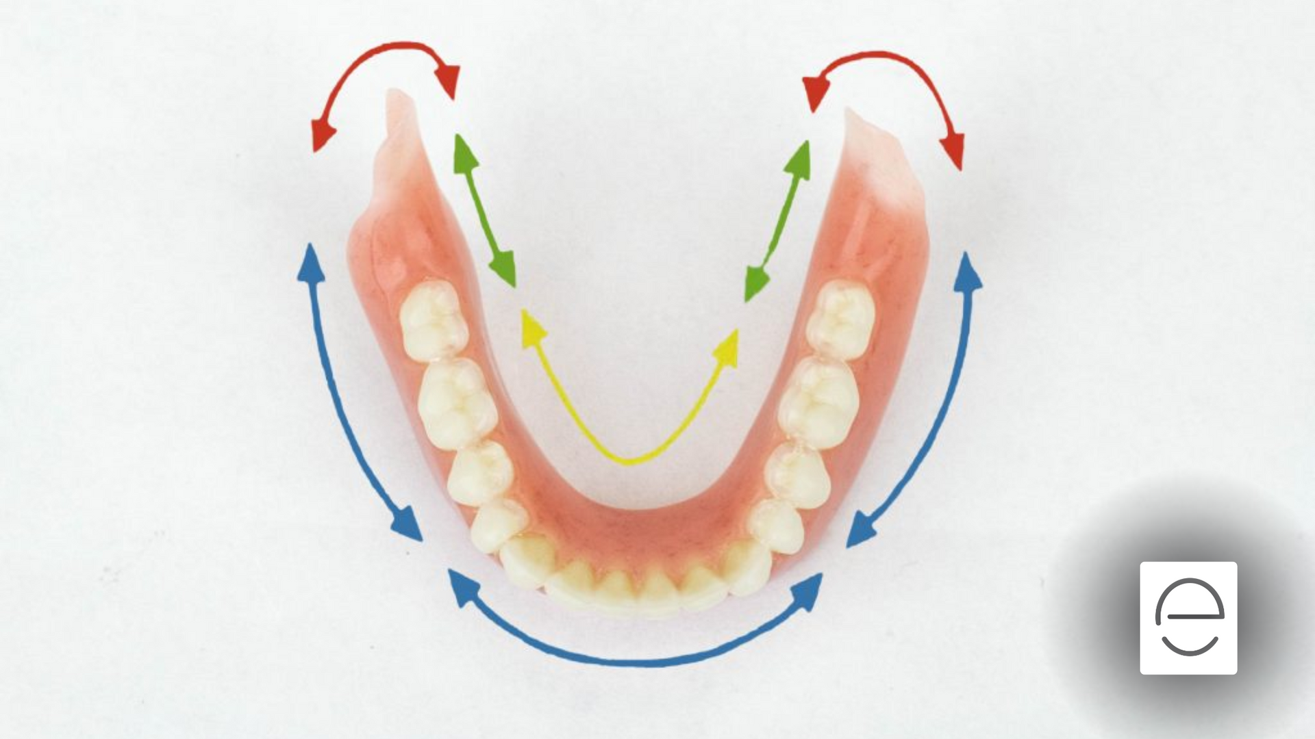 A drawing of a denture with arrows pointing to it