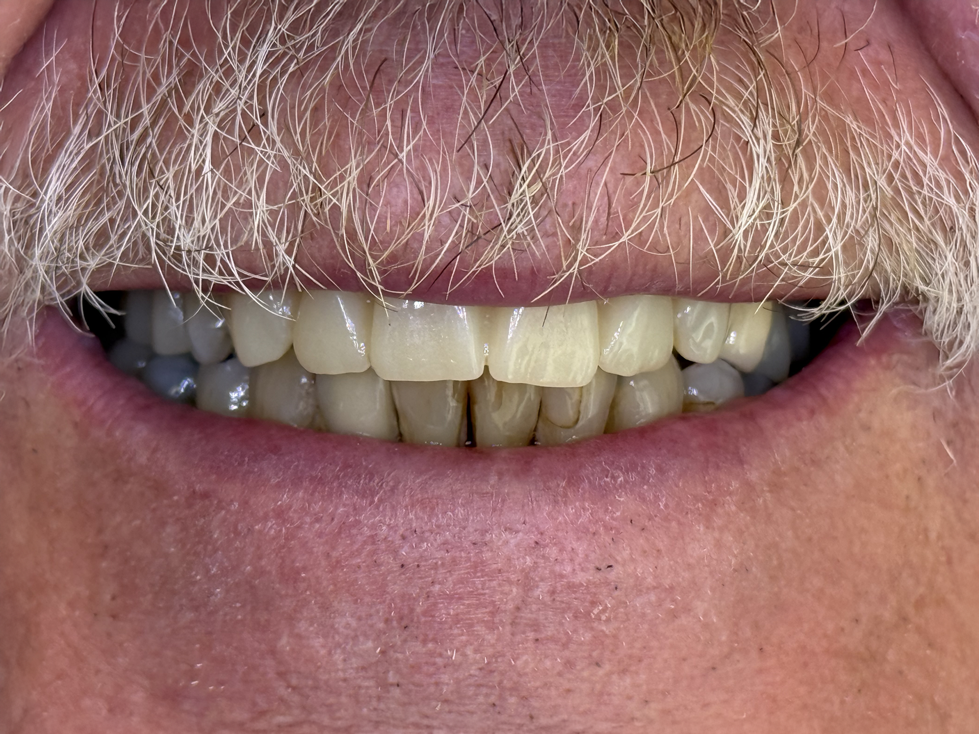 Close-up of a smiling mouth with a thick white mustache and uneven teeth