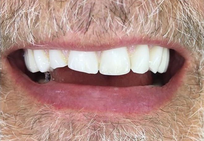 a close up of a man 's mouth with a beard and white teeth | Before and After Denture Treatment | Envision Denture and Implant Centre | Best Denturist In Surrey, British Columbia
