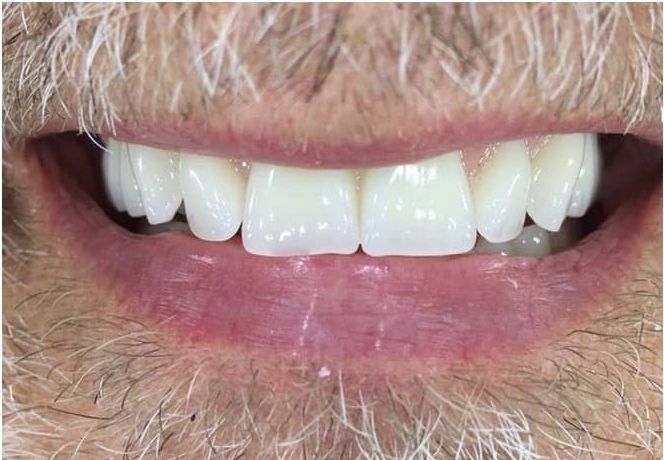 a close up of a man 's mouth with a beard and white teeth | Before and After Denture Treatment | Envision Denture and Implant Centre | Best Denturist In Surrey, British Columbia