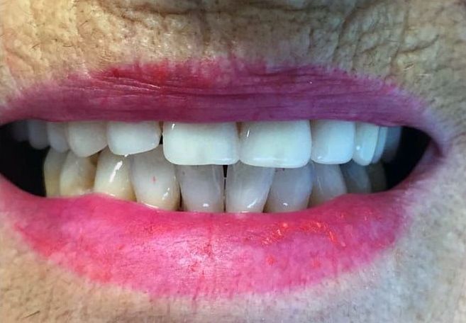 a close up of a woman 's mouth with white teeth and pink lipstick | Before and After Denture Treatment | Envision Denture and Implant Centre | Best Denturist In Surrey, British Columbia