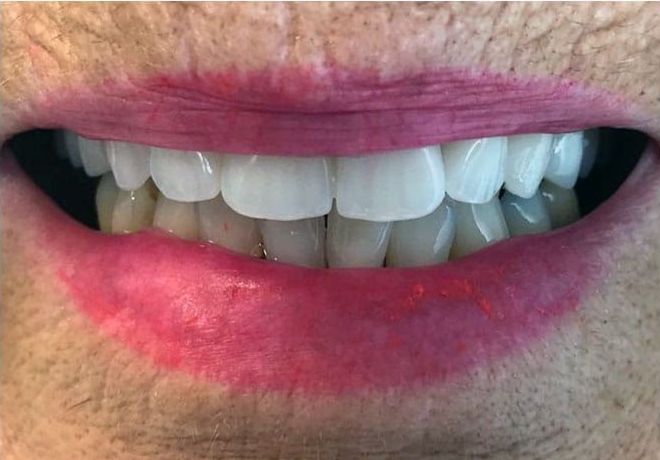 a close up of a person 's mouth with white teeth and red lips | Before and After Denture Treatment | Envision Denture and Implant Centre | Best Denturist In Surrey, British Columbia