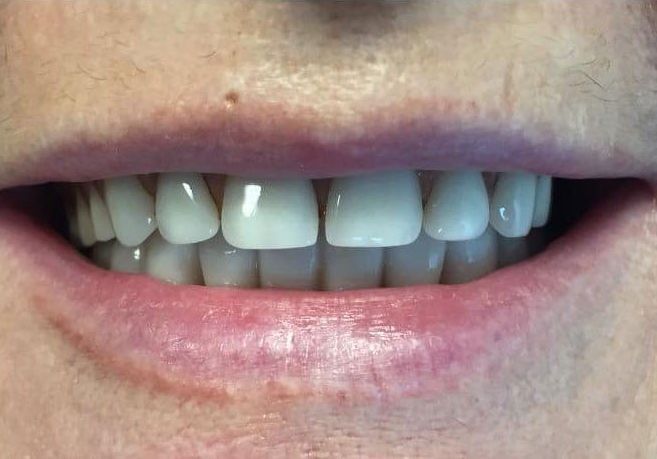 a close up of a person 's mouth with white teeth | Before and After Denture Treatment | Envision Denture and Implant Centre | Best Denturist In Surrey, British Columbia