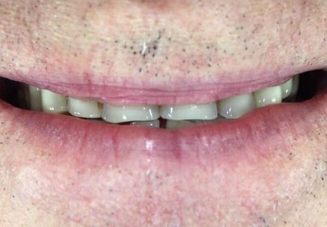 a close up of a man 's mouth with a missing tooth | Before and After Denture Treatment | Envision Denture and Implant Centre | Best Denturist In Surrey, British Columbia