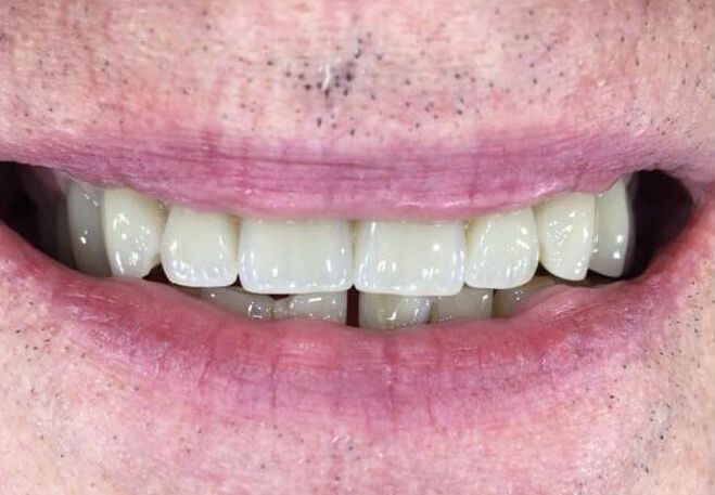 a close up of a man 's mouth with white teeth | Before and After Denture Treatment | Envision Denture and Implant Centre | Best Denturist In Surrey, British Columbia