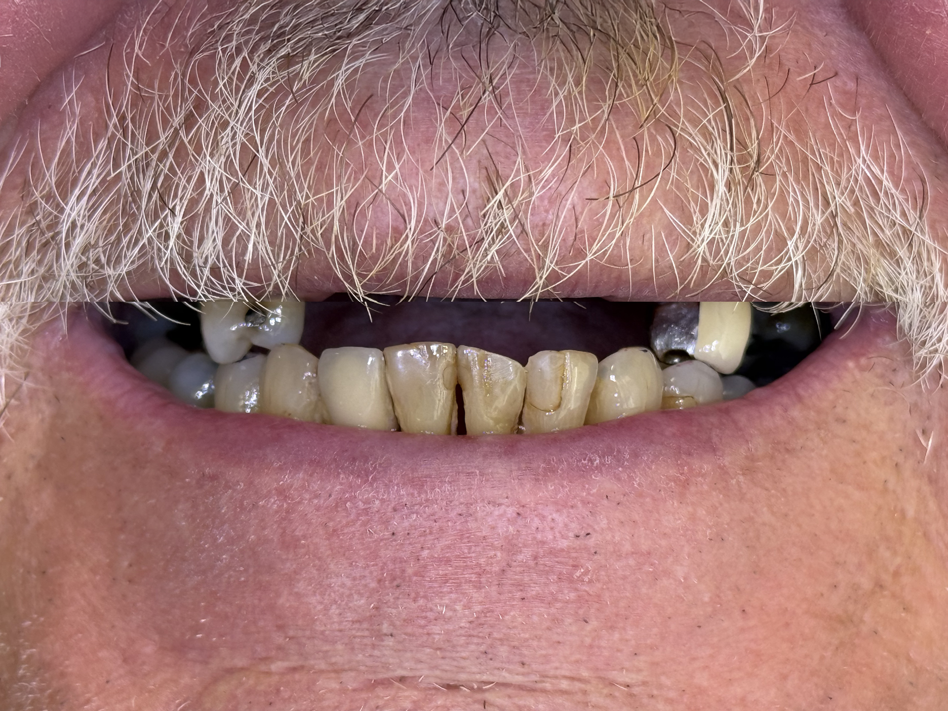 Close-up of a smiling mouth with a gray mustache and yellowed, uneven teeth