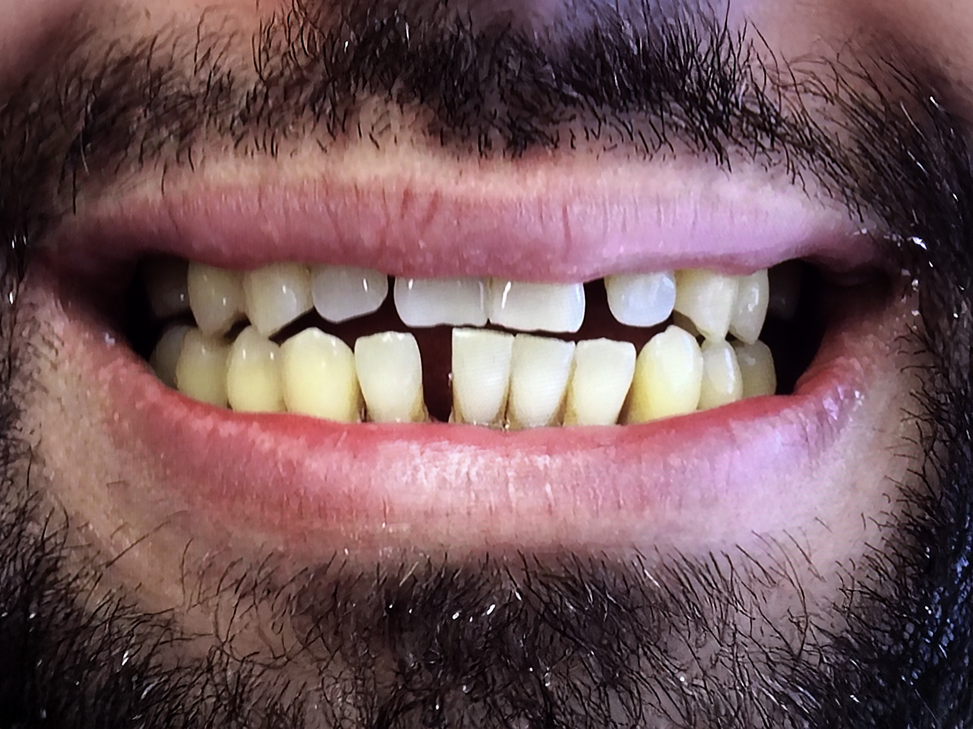 Close-up of a smiling mouth with uneven yellowed teeth and a small gap between the front teeth