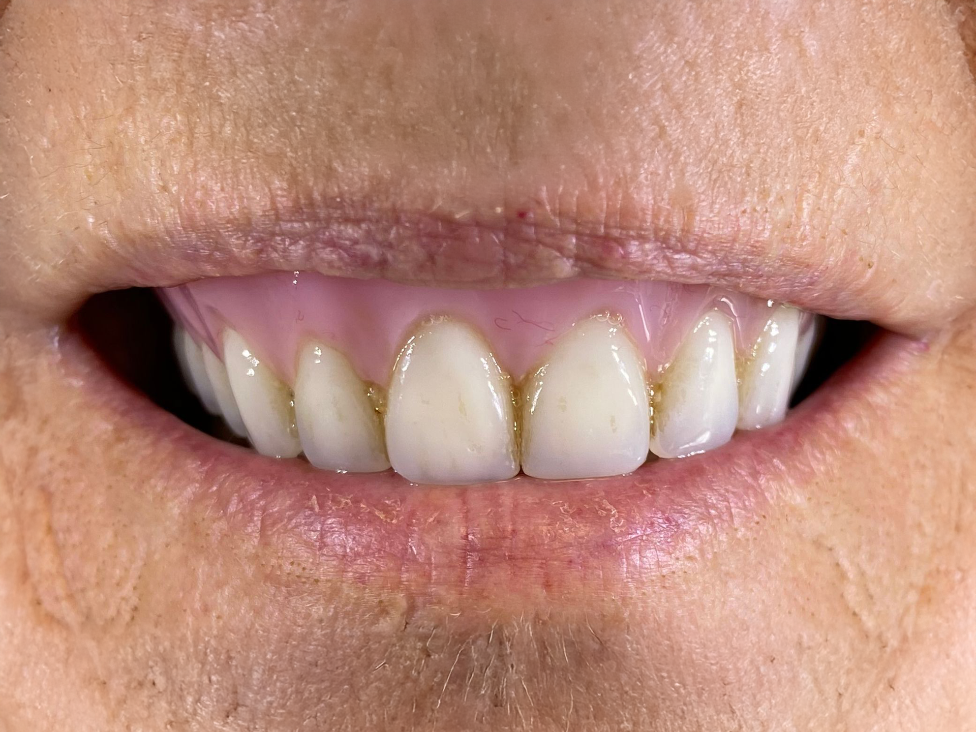 Close-up of a smiling mouth showing white teeth with slight yellowing near the gums