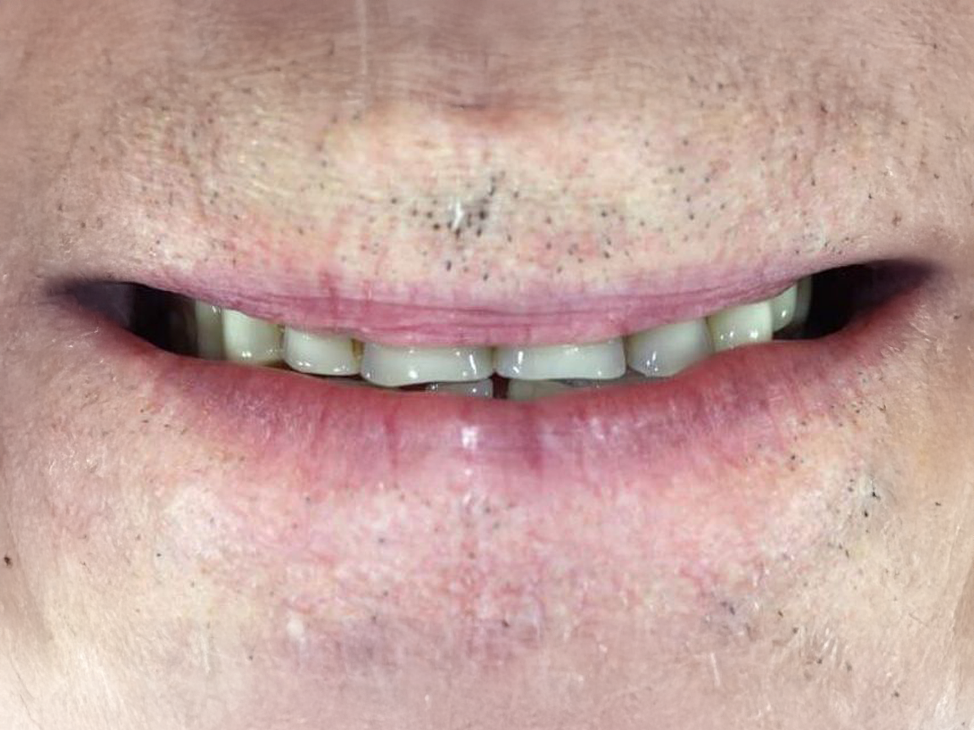 Close-up of a person’s mouth showing stained, uneven teeth and light facial hair above the upper lip
