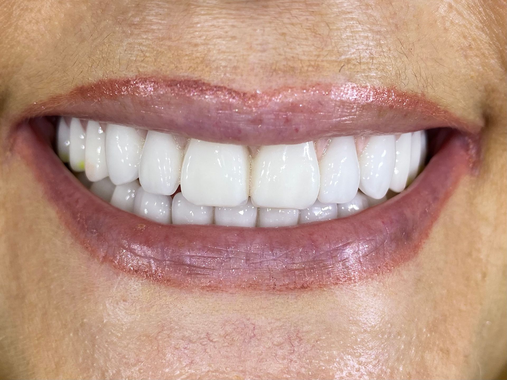 a close up of a woman 's smile with white teeth and red lips | Before and After Denture Treatment | Envision Denture and Implant Centre | Best Denturist In Surrey, British Columbia