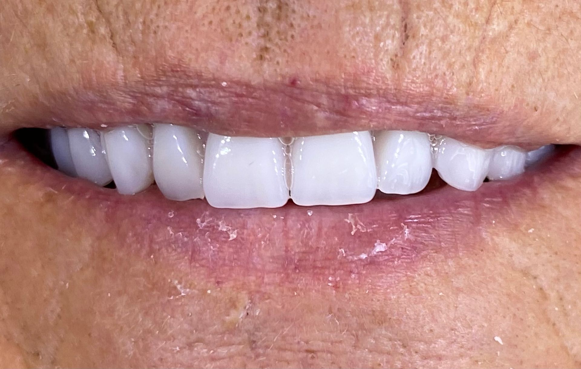 a close up of a man 's mouth with white teeth | Before and After Denture Treatment | Envision Denture and Implant Centre | Best Denturist In Surrey, British Columbia