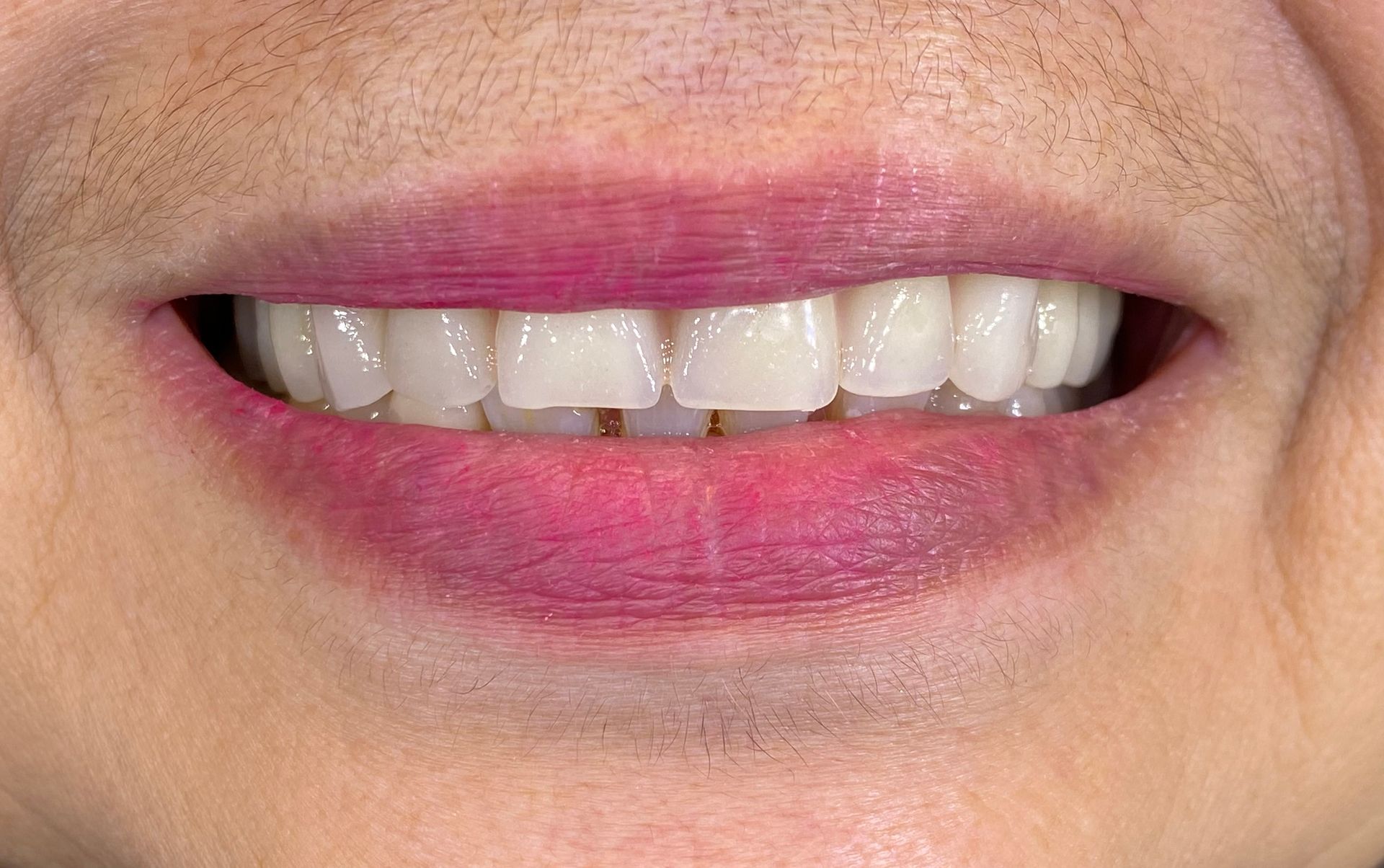 a close up of a person 's mouth with white teeth | Before and After Denture Treatment | Envision Denture and Implant Centre | Best Denturist In Surrey, British Columbia