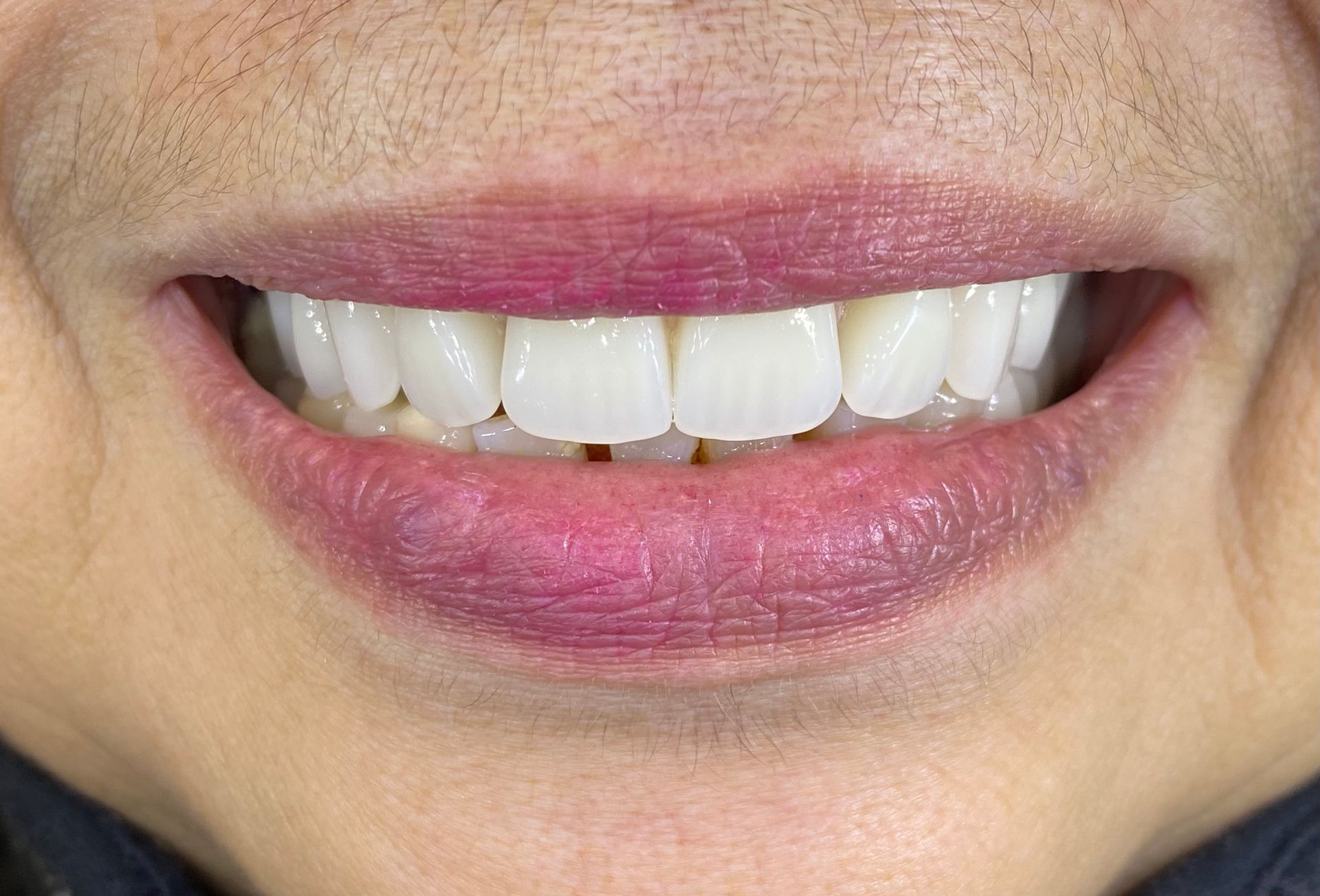 a close up of a person 's mouth with white teeth | Before and After Denture Treatment | Envision Denture and Implant Centre | Best Denturist In Surrey, British Columbia