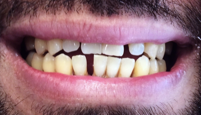 a close up of a man 's mouth with a missing tooth | Before and After Denture Treatment | Envision Denture and Implant Centre | Best Denturist In Surrey, British Columbia