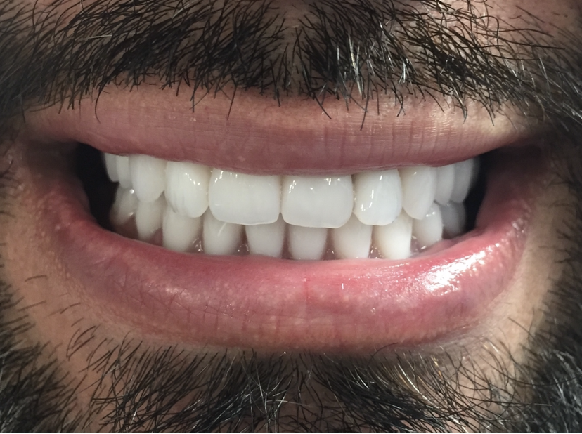 a close up of a man 's mouth with white teeth | Before and After Denture Treatment | Envision Denture and Implant Centre | Best Denturist In Surrey, British Columbia