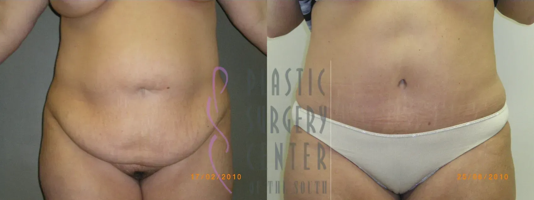 Before and after photos of a person's torso, showing a slimmer abdomen after surgery.
