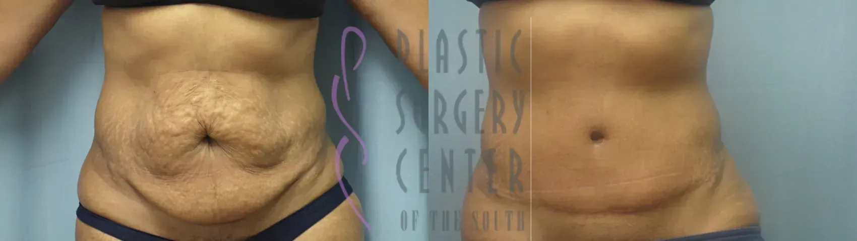 Before and after abdominal surgery. Flabby, loose skin. Smoother, flatter abdomen.