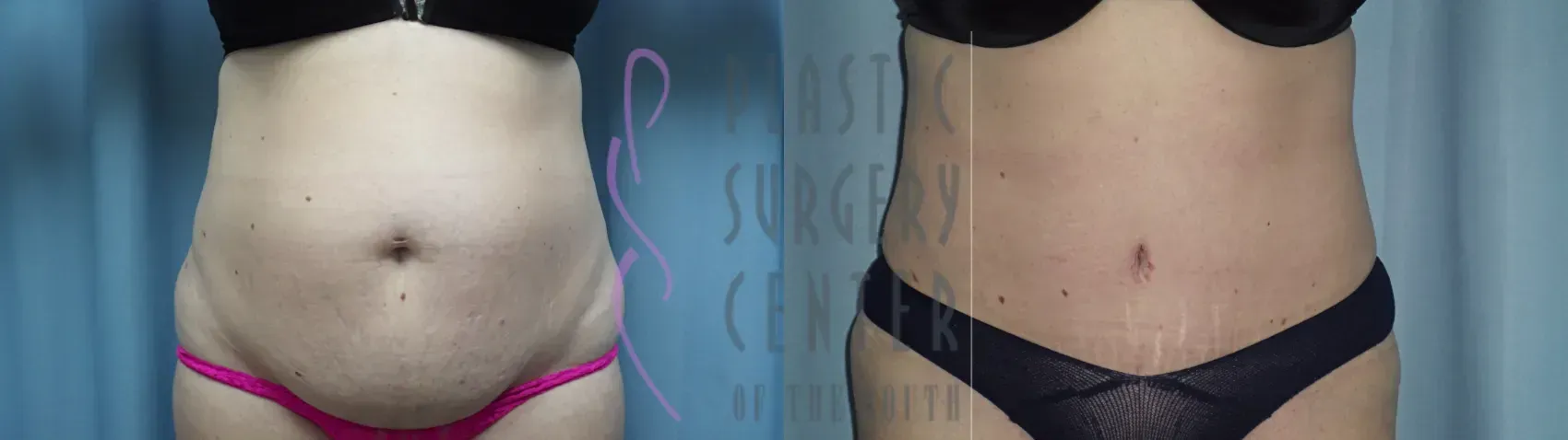 Before and after comparison of a woman's abdomen; one side shows excess skin. The after shows a toned midsection.