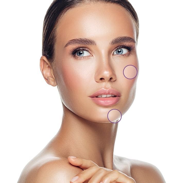 Treatment planner model showing acne areas