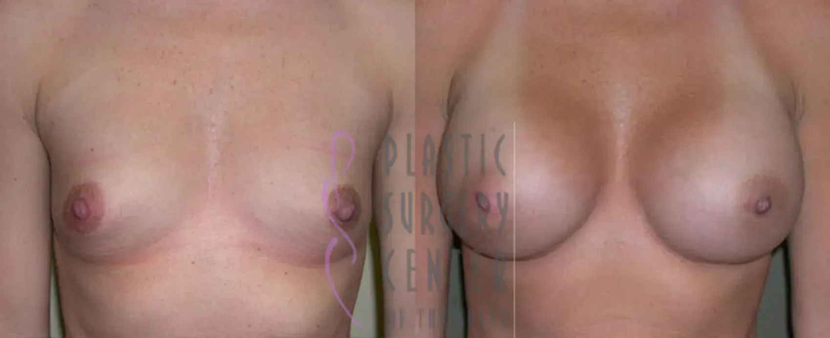 Before and after breast augmentation. Skin-toned chest. Nipples visible. Right side, breasts are fuller.