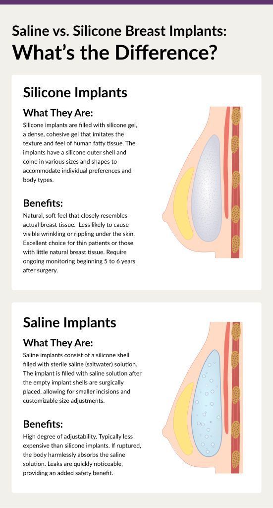 Comparison graphic of silicone and saline breast implants, with cross-section illustrations.