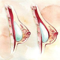 Diagram of two cross-sections of breasts, showing internal structure, with red, beige, and white colors.