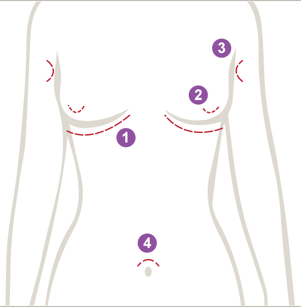 Diagram of a torso with numbered areas indicating surgical incision sites.